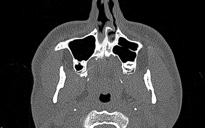 Tomografía de nariz y senos paranasales en corte axial